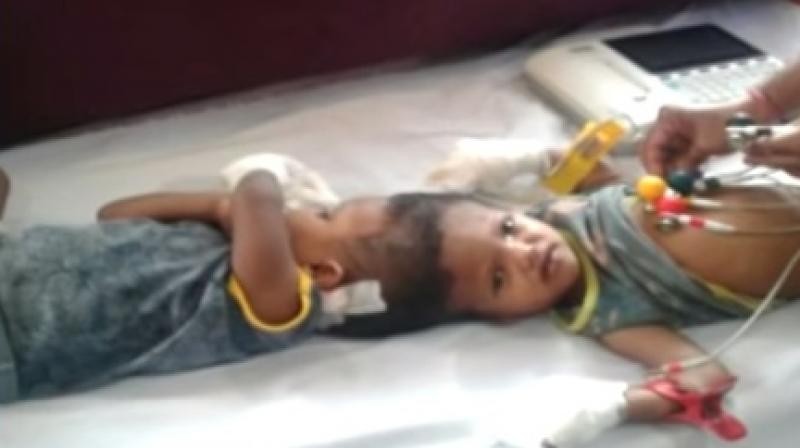 Conjoined Twins From Odisha Successfully Separated