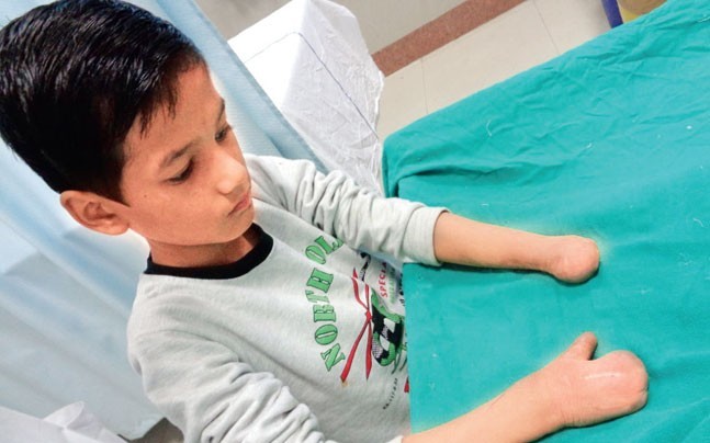 Safdarjung Hospital Doctors Perform ‘Toe-To-Hand’ Surgery On 10-Year-Old Boy Safdarjung Hospital Doctors Perform ‘Toe-To-Hand’ Surgery On 10-Year-Old Boy