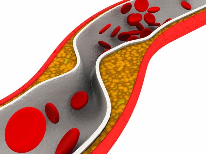 Are Artery-Opening Stents For Chest Pain A Waste Of Time?