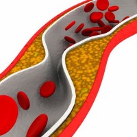 Are Artery-Opening Stents For Chest Pain A Waste Of Time?