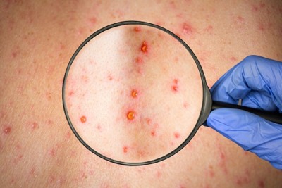 Chickenpox spreading rapidly in Gaya Chickenpox spreading rapidly in Gaya