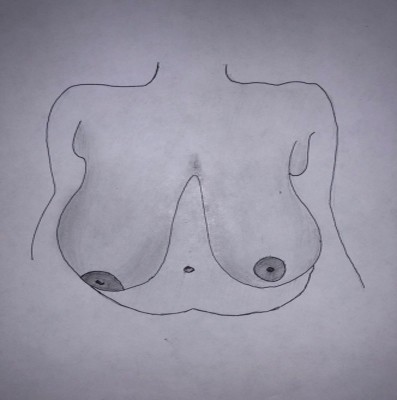 Breast-reduction surgery takes off 2.7 kg from UAE woman's chest Breast-reduction surgery takes off 2.7 kg from UAE woman's chest
