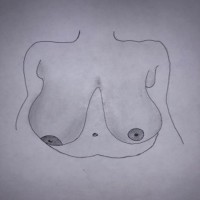 Breast-reduction surgery takes off 2.7 kg from UAE woman's chest