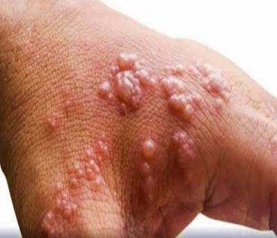 Delhi reports 5th monkeypox case