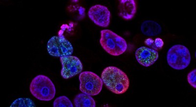 Combination therapy suppresses pancreatic tumour growth: Study Combination therapy suppresses pancreatic tumour growth: Study