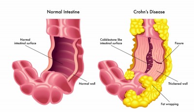 Novel potential therapy for Crohn's disease in children Novel potential therapy for Crohn's disease in children