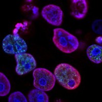 Combination therapy suppresses pancreatic tumour growth: Study