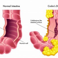 Novel potential therapy for Crohn's disease in children