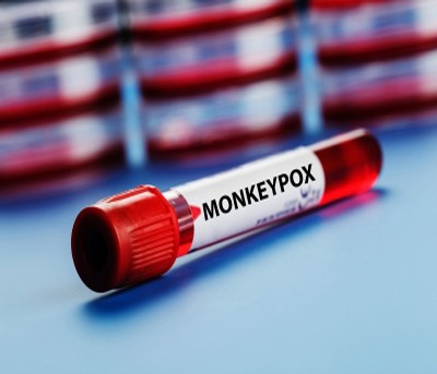 Man with monkeypox-like symptoms admitted to Hyderabad hospital Man with monkeypox-like symptoms admitted to Hyderabad hospital