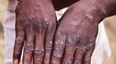 Portugal confirms first female case of monkeypox