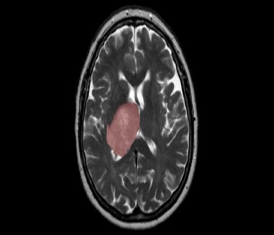How virus infection is linked with progress of brain cancer How virus infection is linked with progress of brain cancer
