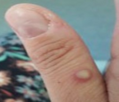 Relief as monkeypox victim suspect in Kolkata tests negative