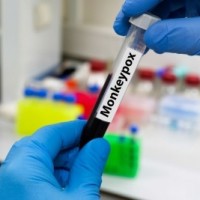 Samples from T'gana's 1st suspected Monkeypox case sent to NIV