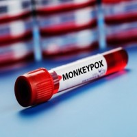 Man with monkeypox-like symptoms admitted to Hyderabad hospital