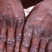 Portugal confirms first female case of monkeypox