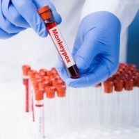 Suspected case of monkeypox in UP