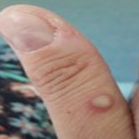 Relief as monkeypox victim suspect in Kolkata tests negative