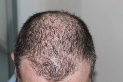 Hair loss is new post Covid complication: Doctors Hair loss is new post Covid complication: Doctors
