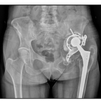 Fortis hospital conducts largest 3D printed hip implant in India