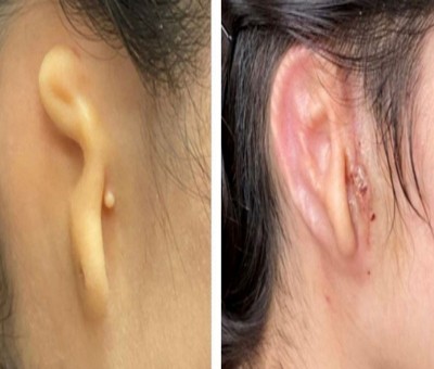 Woman implanted with 3D-printed ear made from her own cells Woman implanted with 3D-printed ear made from her own cells