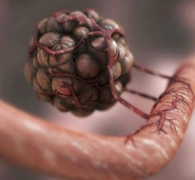 Gallbladder, biliary tract cancer cases up 76% in 3 decades Gallbladder, biliary tract cancer cases up 76% in 3 decades