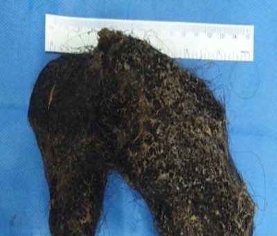 Doctors at Hyderabad hospital remove hairball from Omani girl Doctors at Hyderabad hospital remove hairball from Omani girl