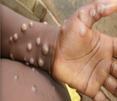 Monkeypox scare: TN district collectors on alert across the state