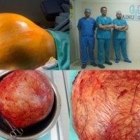 Doctors at Hyderabad hospital remove football-sized kidney tumour