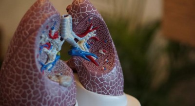 Cannabis oil led to lung cancer regression in octagenarian Cannabis oil led to lung cancer regression in octagenarian