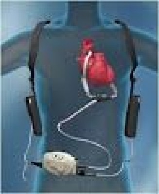 Kerala's first artificial heart implantation done successfully Kerala's first artificial heart implantation done successfully