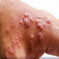 ICMR performs genome characterisation of monkeypox cases, identifies 3 sub-clusters among A.2 lineage in India