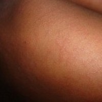 Sri Lanka, Maldives eliminate measles, rubella in SE Asia: WHO
