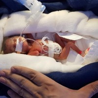 Rainbow Children hospital doctors of Vijayawada perform miracle: Save 450 gms newborn baby