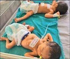 लखनऊ के किंग जॉर्ज मेडिकल यूनिवर्सिटी के डॉक्टरों ने सर्जरी कर अलग किए जुड़वा बच्चे लखनऊ के किंग जॉर्ज मेडिकल यूनिवर्सिटी के डॉक्टरों ने सर्जरी कर अलग किए जुड़वा बच्चे