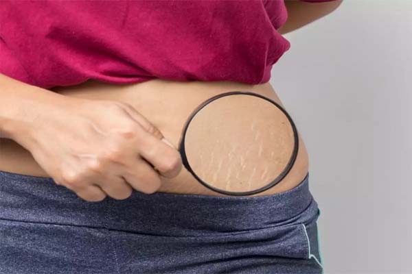 स्ट्रेच मार्क्स से छुटकारा पाएं स्ट्रेच मार्क्स से छुटकारा पाएं