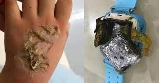 अचानक समार्टवाच की बैटरी फटी और जल गई बच्ची, बाल-बाल बची जान -विस्फोट के कारण बच्ची के हाथ के पिछले हिस्से में थर्ड-डिग्री बर्न हुआ है अचानक समार्टवाच की बैटरी फटी और जल गई बच्ची, बाल-बाल बची जान -विस्फोट के कारण बच्ची के हाथ के पिछले हिस्से में थर्ड-डिग्री बर्न हुआ है