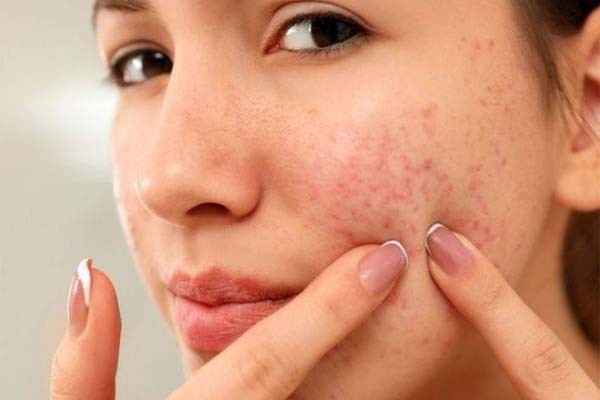 त्वचा की समस्याओं से राहत के लिए करें ये उपाय त्वचा की समस्याओं से राहत के लिए करें ये उपाय