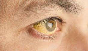 आंखों में पीला धब्बा हो तो हो जाए सावधान  -हो सकता है डिमेंशिया का खतरा 