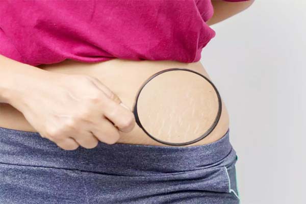 स्ट्रेच मार्क्स से छुटकारा पाएं स्ट्रेच मार्क्स से छुटकारा पाएं