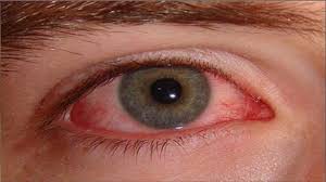आंखें लाल होना भी है कोरोना के लक्षण -आंसू गिरते हो तो भी रहे सावधान