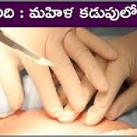 మహిళ కడుపులో కాటన్ ప్యాడ్స్